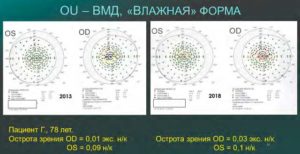 Приведен пример сохранения зрительных функций методом коррекции микроциркуляции при поражении сетчатки в течение пяти лет