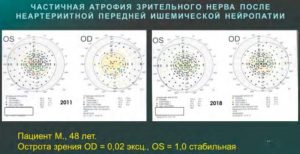 Приведен пример сохранения остаточных зрительных функций методом коррекции микроциркуляции при атрофии зрительного нерва в течение семи лет